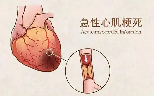 血管斑块的危害-贝斯曼健康筛查