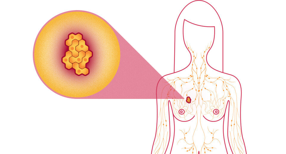 贝斯曼乳腺自查仪，母亲、护士们预防乳腺疾病的好帮手